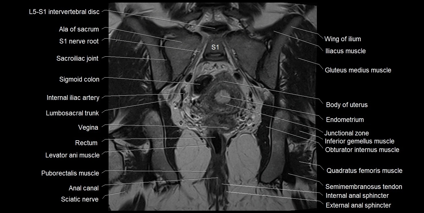 female pelvis coronal cross sectional anatomy image 23.webp